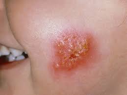 Image result for Impetigo