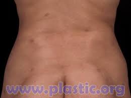 Apr 27, 2020 · laser lipo and coolsculpting are both minimally invasive procedures to reduce fat in the body. Warning About Laser Liposuction James M Nachbar Md Facs Scottsdale Phoenix Arizona