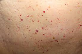 Using laser therapy, you can have your cherry angioma speedily removed. Cherry Angioma Integrity Paramedical Skin Practitioners