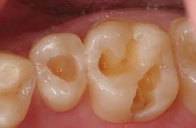 But, no matter how annoyed you may be, the good news is that cavities can be effectively fixed. Dental Fillings Oceansight Dental Implants