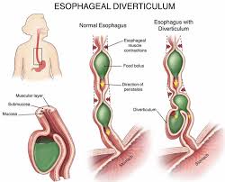 Check spelling or type a new query. Esophageal Diverticulum Causes Types Symptoms Diagnosis Treatment