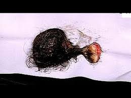 Check spelling or type a new query. Ovarian Dermoid Youtube