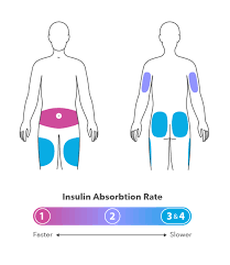 Clean the top of the insulin vial with alcohol. How To Take Insulin Injections Injection Sites Tips More