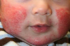 Image result for Atopic Dermatitis