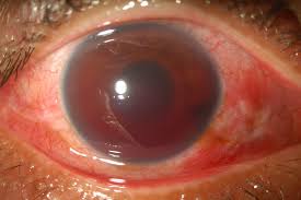 Image result for Hyphema