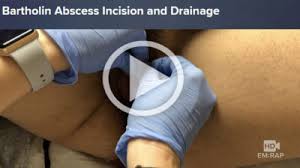 Image result for Bartholin's gland abscess