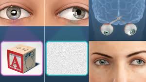 Image result for Strabismus