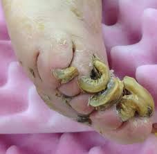 Image result for Koilonychia feet