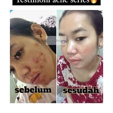 Jual PAKET HEMAT ACNE 2
