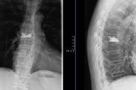 Osteoporose Behandlung Therapie Bei Wirbelfrakturen Dr Christopoulos