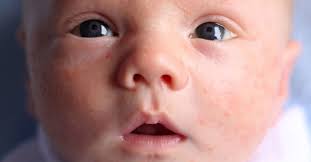 There will be no suds or bubbles, as there are with. Does My Baby Have Acne Or A Rash Diagnosis And Treatment