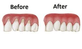These 5 Natural Ingredients Will Help Your Receding Gums Grow Back Teeth Health Gum Health Health Remedies