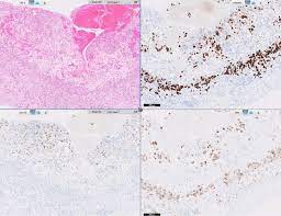 Maybe you would like to learn more about one of these? Pathology Outlines Epithelial Membrane Antigen Ema