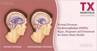 Image result for Hydrocephalus