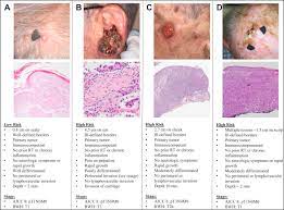 It may also present as a raised area with ulceration. Cutaneous Squamous Cell Carcinoma Dermatologic Clinics