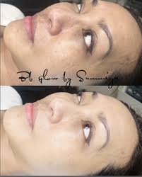 Smooth, repaired, lightened, lifted, firmened and detoxified skin. Bb Glow Treatment With Led Light Therapy Lashes Brows By Summiya