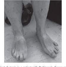 Pdf Botulinum Toxin For Foot Dystonia In Patients With Parkinson S Disease Having Deep Brain Stimulation A Case Series And A Pilot Study Semantic Scholar