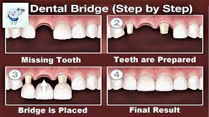A cantilever bridge is used when there are teeth on only one side of the open space. Dental Bridge Procedure Step By Step Youtube