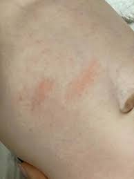 Image result for vyrážka u dětí