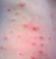 This is an infection of the hair follicles with pseudomonas folliculitis bacteria. Pin On Awareness In Memory Of Silas Pseudomonas