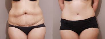 Check spelling or type a new query. Tummy Tuck In Webster Tx Houston Plastic Reconstructive Surgery