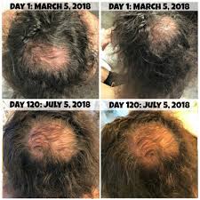 Viviscal densifying shampoo and conditioner 8.45 oz set $23.63 ( $1.40 / 1 fl oz) in stock. Irestore Laser Hair System 6 Month Review August 2020 Update Drugstore Divas