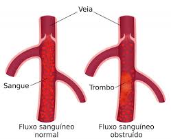 Una trombosis venosa es la formación de un coágulo de sangre en el interior de una vena, que puede deberse a un problema de hipercoagulabilidad por otra parte pueden surgir ciertas lesiones en la pared vascular a causa de una cirugía, una herida o una inflamación. Trombosis Causas Sintomas Y Tratamientos Enfermedades Definiciones Y Conceptos