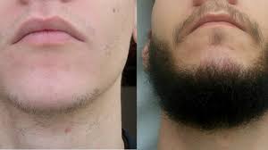 But if you have normal blood pressure and you use too much of it you can end up with a lower blood pressure than what is healthy, resulting in. Minoxidil 5 For Beard Results Novocom Top