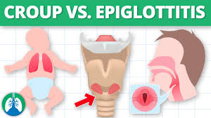 Image result for Epiglottitis