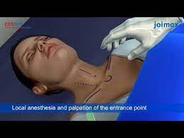 Operatiile de hernie de disc, cu laser, realizate la timisoara, au trezit interesul multor persoane care au afectiuni lombare sau apartinatorilor acestora. Operatie Hernie De Disc Cervicala Animatie Youtube