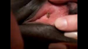 Maggot entering black woman's urethra! - XVIDEOS.COM