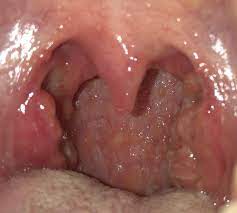 Ebv can cause infectious mononucleosis, also called mono, and other illnesses. Glandular Fever Or Infectious Mononucleosis Dr Jeeve Ent Specialist