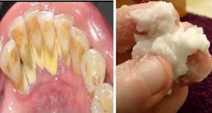 Without scaling in 3 minutes, white teeth and healthy as learn The Best Homemade Remedy To Remove Plaque Painlessly Homemade Remedies Remove Tartar Remedies