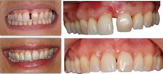 Image result for Dentition