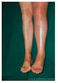 Deep Vein Thrombosis Dvt Dvt Awareness Hypertensive Emergency Surgical Nursing