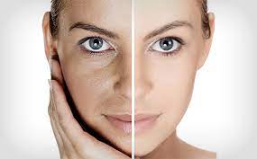 *rejuvenation (aging) reversing the aging process *rejuvenation (river) when the base level that a river is flowing down to is lowered * rejuvenation (album) 1974 funk. Charlotte Skin Rejuvenation Treatment Makes You Look Younger Hospitalpuigcerda