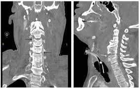 Check spelling or type a new query. Left Image Coronal Reformatted Cervical Spine Post Contrast Shows The Download Scientific Diagram