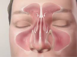 Image result for Sinus Surgery