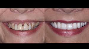 If you have any concerns, or would like to. Can Loose Teeth Be Saved To Pull Or Not To Pull Youtube