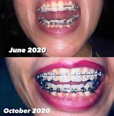 Discover now the most modern transparent aligner system and transform your smile. 4 Months Progress Just Had My Tightening Today And My Teeth Are The Most Sore They Ve Been Throughout This Four Months Braces