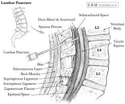 Ask or use assistant to draw patient's legs up to their chest. Procedure How To Do A Lumbar Puncture