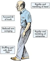 Many of the symptoms are due to a loss of neurons that produce a chemical messenger in your brain called. Pathology Definition Parkinson Disease Medical Zone