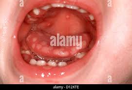 Image result for Oral herpes roof of mouth