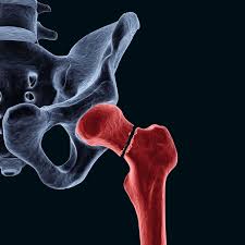 Image result for Femur Bone