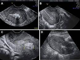 Ultrasound education specialist and clinical consultant charleston, south carolina. A See And Treat Office Procedure For Retained Products Of Conception Removal After Normal Vaginal Delivery Using Manual Vacuum Aspiration Preliminary Efficacy And Reproductive Outcomes Journal Of Minimally Invasive Gynecology