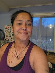 Introduction to Neurofibromatosis Support Group from New Zealand