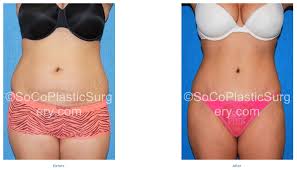 It can take up to three months for the swelling and bruising to go down completely, and it may take longer than that for your scar to fade. Tummy Tuck Recovery Time Irvine Tummy Tuck Orange County Kyle Song Md Irvine Plastic Surgery