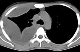 It has a higher yield than that of blind pleural biopsy in the diagnosis of malignancy. Pleural Effusion Diagnosis Treatment And Management Abstract Europe Pmc