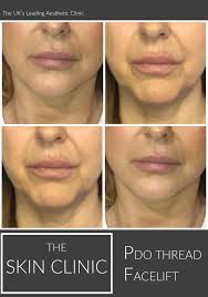 Amazing PDO Thread Lift as performed