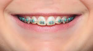 Magical, meaningful items you can't find anywhere else. Colored Braces And Bands Murray Orthodontics